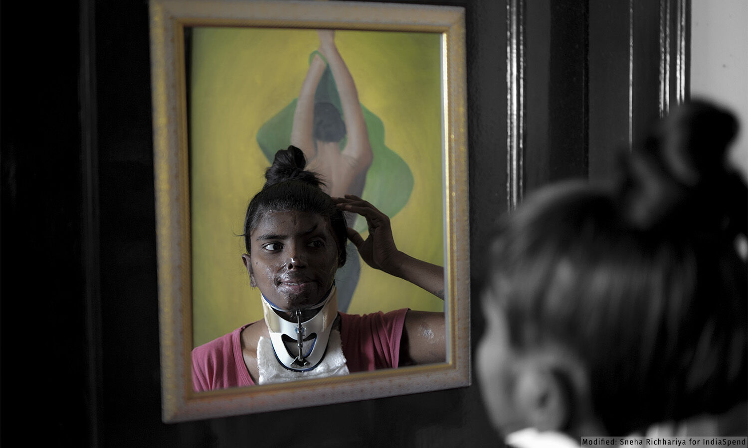 Scare of the Scars Acid Attacks and Skin Scarring